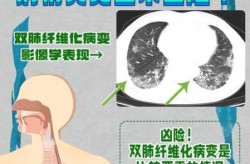 肺部病毒有哪几种严重，肺病最严重的是哪种病