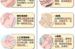 二次感染了有什么症状，艾滋病二次感染症状有哪些