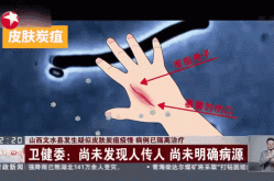 山西文水县疑发生皮肤炭疽疫情（山西文水炭疽病）