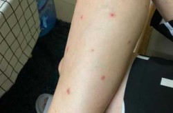无症状感染者有什么症状表现，感染hpv有什么症状