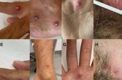 天津发现一例猴痘病例，天津发现一例本土病例