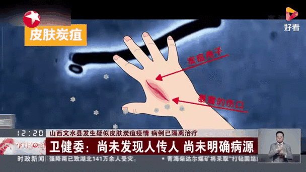 山西文水县疑发生皮肤炭疽疫情（山西文水炭疽病）