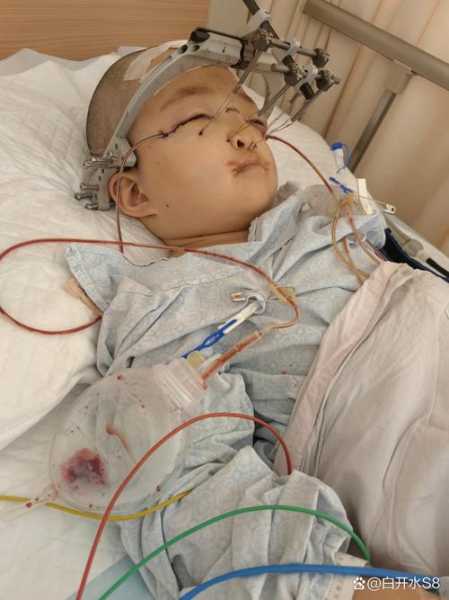 纽约70%染不明综合征儿童进icu（加州女儿综合征）