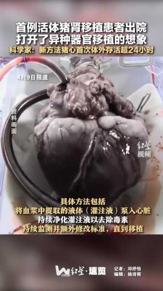 接受猪心脏移植病人或因猪病毒而死(猪心脏移植)