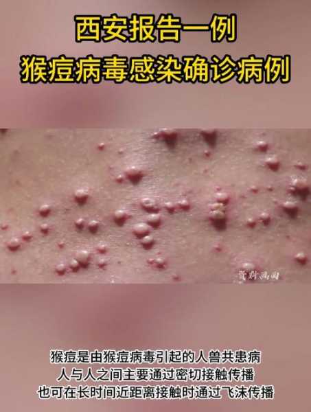 猴痘病毒威胁全球专家分析(猴痘病毒的真人照片)