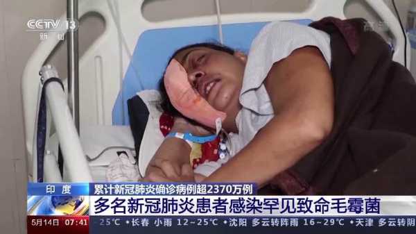印度毛霉菌病病例已超3万例(毛霉菌是什么病)