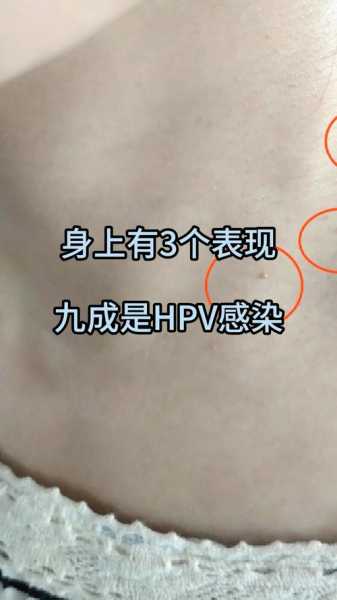 女性hpv病毒早期症状，hpv初期有什么症状