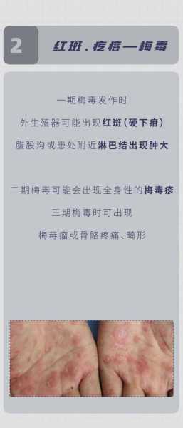 怎么才知道自己得了性疾病,怎么判断自己有没有得性疾病