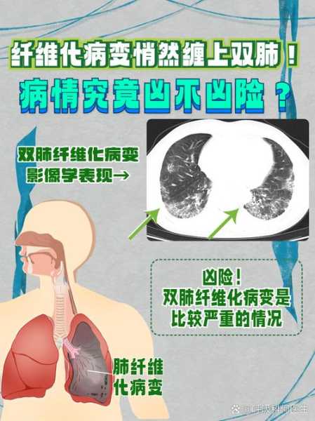 肺部病毒有哪几种严重,肺病最严重的是哪种病