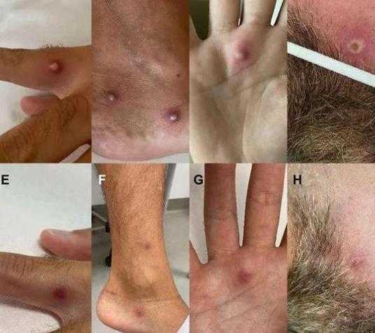 天津发现一例猴痘病例,天津发现一例本土病例